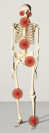 Foto eines Skeletts, die für Verschleiß anfälligen Gelenke sind markiert